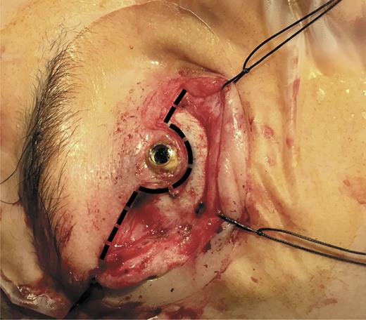 Fig. 3. Surgical incision using the initial tarsorrhaphy scar in a “U” shape with respect to the optical stem.