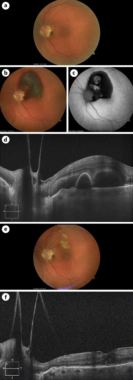 Fundus photo from before the subretinal hemorrhage (a) demonstrated an optic disc melanocytoma in the 4 o’clock position. Fundus photo (b) and fundus autofluorescence (c) after presumed CNVM formation demonstrated subretinal hemorrhage emanating from the optic disc melanocytoma and abutting the fovea. OCT (d) demonstrated subretinal and sub-RPE hemorrhage consistent with the fundus examination. Fundus photo from after resolution of the presumed CNVM and hemorrhage (e) demonstrated 2 distinct areas of residual subretinal fibrin. OCT (f) from after aflibercept treatment course demonstrated resolution of hemorrhage and subretinal fluid consistent with presumed regressed CNVM.