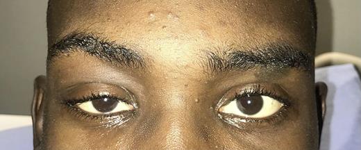 Right upper eyelid swelling and ptosis.
