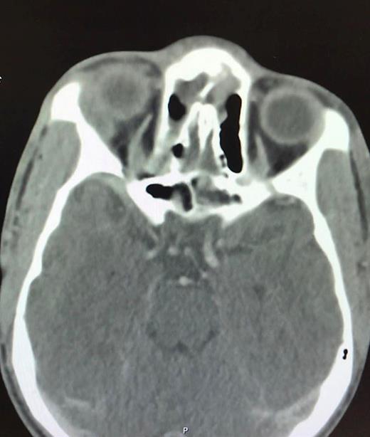Axial computed tomography (CT)-scan: lenticular shaped extraconal mass along the right superolateral orbit of 2 × 0.7 × 1.2 cm.