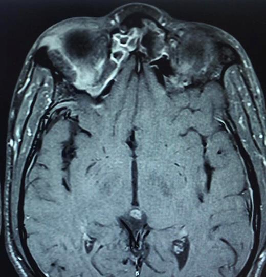 Axial magnetic resonance imaging (MRI): rim enhancement-like of the hypointense extraconal mass on T1 weighted.
