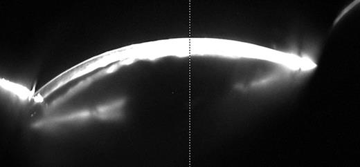 Scheimpflug image showing a partially detached lower part of the DSAEK graft (left-hand side), 7 weeks after DSAEK.