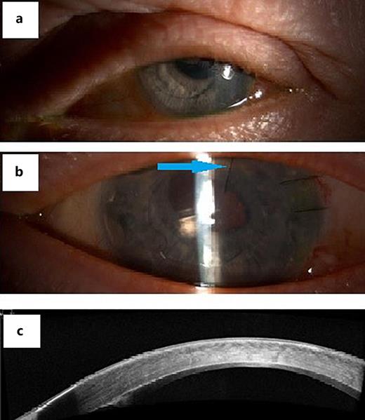 Photo slit-lamp images 13 weeks after DSAEK surgery. a DSAEK graft is reattached and cleared. b Suture in the graft at 1 o’clock (blue arrow). c Anterior segment OCT showing attached DSAEK graft 13 weeks after DSAEK surgery.