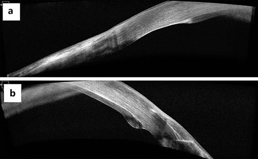 Anterior segment OCT 5 months after DSAEK surgery showing that the graft is still attached. a is a scan in the lower nasal quadrant and b is in the lower temporal quadrant.