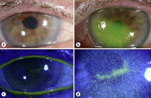 Clinical photographs at 1-week follow-up. a OD healing epithelial defect. b OS epithelial defect with fluorescein staining. c, d OD healing epithelial defect under blue light illumination.