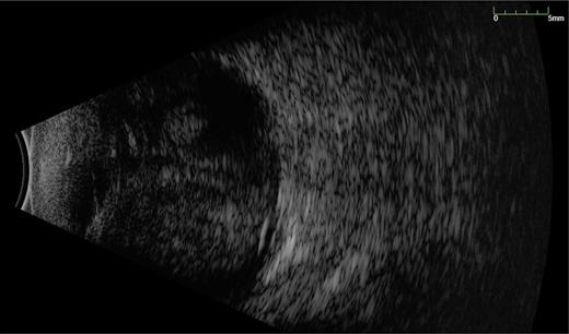 B-USS of the preoperative appearance of case 1 demonstrating large macular haemorrhage, choroidal effusions of kissing configuration.