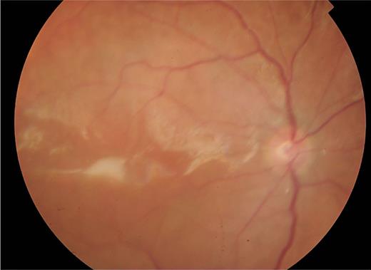 Fundus photograph of postoperative appearance of case 1, demonstrating flat retina with complete resolution of haemorrhage.