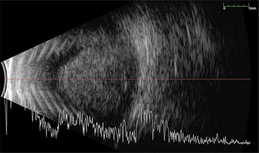B-USS of the preoperative appearance of case 2, demonstrating massive suprachoroidal haemorrhage.