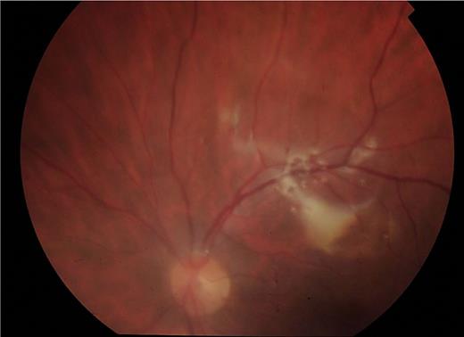 Fundus photograph of postoperative appearance of case 2, demonstrating flat retina under oil with complete resolution of haemorrhage.