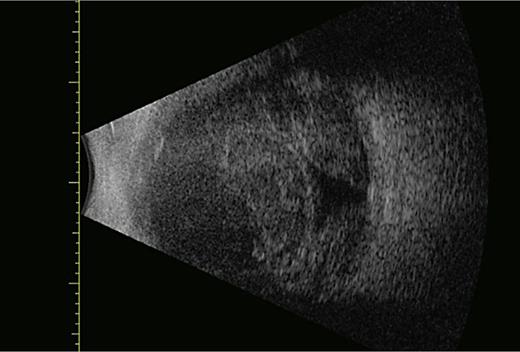 An ultrasound of case 3, demonstrating a central opening in the vitreous space with remaining SCH in the 4 quadrants (rebleed).