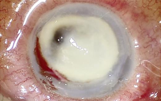 Legend limbus to limbus keratitis with stromal melting, perforation, and iris plugging.