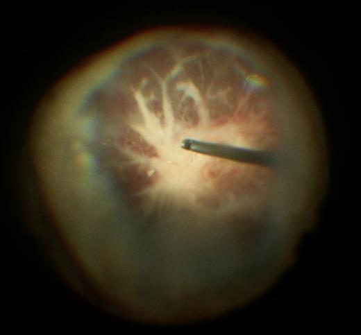 Legend retinal vasculitis and necrosis during PPV.