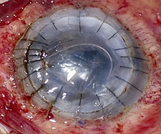 Legend tectonic graft with additional sutures due to leaking.