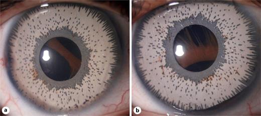 BrightOcular cosmetic implants with residual iris strands in pupil area. a Right eye. b Left eye.