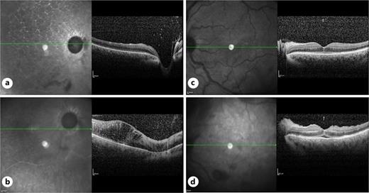 a Preoperative right eye’s macular OCT showing diffuse retinal atrophy. b Postoperative right eye’s macular OCT showing clinical features of CCRVO. c Preoperative left eye’s macular OCT. d Postoperative left eye’s macular OCT showing features of hypotensive maculopathy.