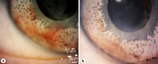 a Slit-lamp photograph showing extensive angle neovascularization of the right eye, mostly involving the inferior and temporal quadrants growing over the artificial implant. b Slit-lamp photograph showing regression of the neovascularization after three intravitreal injections of bevacizumab.