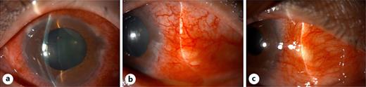 Slit-lamp examination of the anterior segment. a At the initial visit, the left eye exhibited diffuse scleritis and a peripheral corneal ulcer with no lucid interval to the limbus, accompanied by anterior uveitis. b Four days after the initial visit, nodular scleral thickening and scleral injection developed in the left eye, supporting the diagnosis of nodular scleritis. c Nineteen days after the initial visit, the right eye also exhibited nodular scleral thickening and scleral injection, consistent with nodular scleritis.