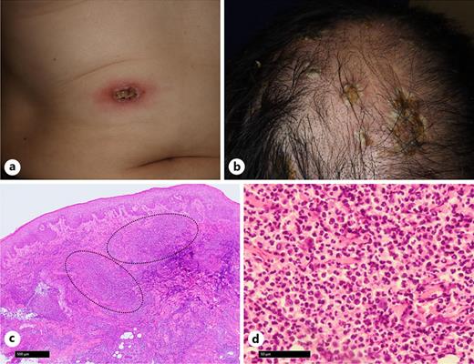 Skin lesions and histopathological findings. a Ulcers with pustules observed on the right upper quadrant of the trunk. b Ulcers with pustules observed on the parietal scalp. c Histopathology of the skin biopsy revealed abscess formation within the dermis (dotted circle) (hematoxylin and eosin stain). d High-power view of the abscess shown in (c) demonstrated dense accumulation of neutrophils (hematoxylin and eosin stain).