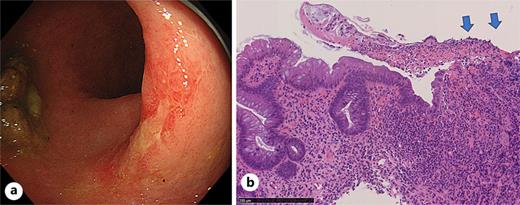 Gastrointestinal and histological findings. a Lower gastrointestinal endoscopy showing active moderate inflammation on the left side of the colon, with marked erythema, absent vascular pattern, and ulceration. b Histology of the colon biopsy revealed crypt atrophy and distortion, consistent with ulcerative colitis. Active inflammation with surface erosion was also observed (arrows) (hematoxylin and eosin stain).