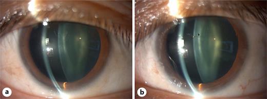 Slit-lamp findings at 19 months after the initial visit and 9 months after discontinuation of oral prednisolone. a Right eye with complete resolution of scleritis. b Left eye with complete resolution of scleritis; pigmentation on the lens is attributed to anterior uveitis noted at the initial visit.
