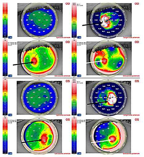 Fig. 2. Scheimpflug tomography shows KC in both eyes. Anterior tangential algorithm and elevation maps (black arrows); posterior elevation maps (white arrows).