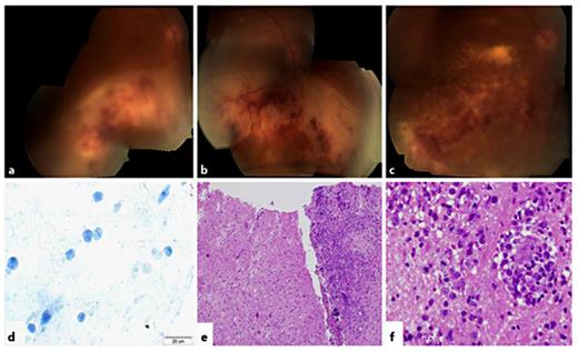 Fig. 1. Posterior segment presentation and histopathological examination. a Vitritis and a white-yellow lesion with few retinal and subretinal hemorrhages in the inferior retina, without macular or optic disc involvement. b The inferior lesion advanced to the inferior border of the optic disc and involved the macula but not the fovea. c The subretinal lesion crossed the fovea and advanced to the temporal border of the optic disc. d CD3 staining showed strongly immunoreactive cells. e Brain biopsy. f CNS lymphoma: large lymphocytes with giant nucleus, open chromatin and few mitoses.