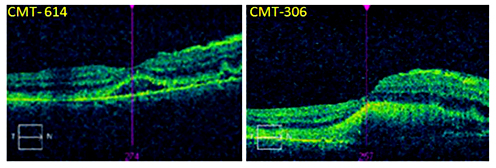 Fig. 2. OCT of the horizontal foveal area. a Presence of subretinal fluid after intravenous acyclovir and oral prednisone treatment. MCT was measured 614 µm. b Resolution of the subretinal fluid and MCT reduction to 306 µm after intravitreal Foscarnet and Kenalog injections. c The subretinal lesion crossed the fovea and farther advanced to the temporal border of the optic disc.
