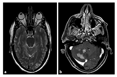 Fig. 3. MRI. a T2 axial cross-section was normal. b T2 axial cross-section showing several new space-occupying lesions in the right cerebellum.