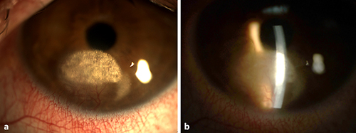 Fig. 1. Deep corneal stromal vascularization and lipid deposition. a Diffuse illumination. b Direct illumination.