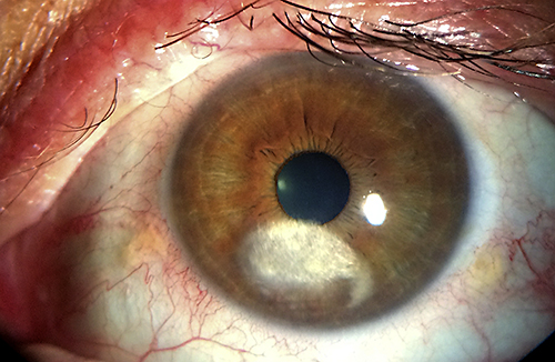 Fig. 2. Diminution of abnormal corneal vessels following bedtime eye covering.