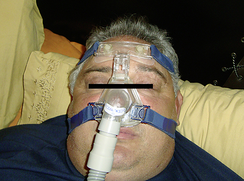 Fig. 3. Loose mask application leading to air leakage towards the left hemiface.