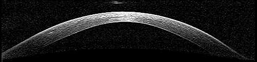 Fig. 2. Anterior segment imaging at month 1 post ACIF-PIOL implantation.