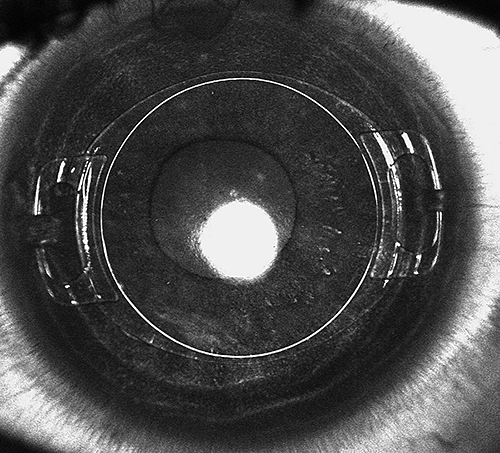 Fig. 3. The implanted ACIF-PIOL.