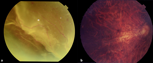 Fig. 1. Pre- and postoperative funduscopy images in the right eye of case 1. Bullous rhegmatogenous retinal detachment developed from the upper quadrants (a). Following scleral buckling surgery, the retina was well reattached and corrected visual acuity improved from 0.01 to 0.6 (b).