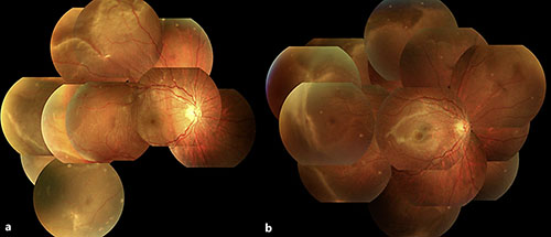 Fig. 2. Pre- and postoperative funduscopy images in the right eye of case 2. Bullous rhegmatogenous retinal detachment developed from the temporal two quadrants (a). Following scleral buckling surgery, the retina was well reattached and corrected visual acuity improved from 0.4 to 0.9 (b).