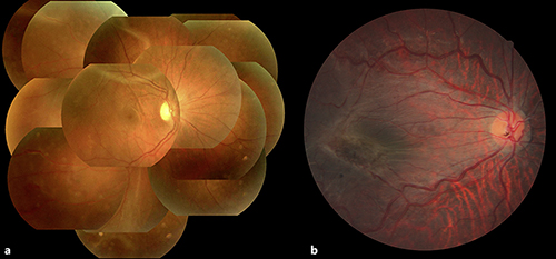 Fig. 3. Funduscopy images of case 3. Preoperative (a) and postoperative (b) funduscopy images of the patient’s right eye. Retinal detachment developed from the upper temporal quadrants. Following scleral buckling surgery, the retina was reattached; however, localized downward redetachment occurred and epiretinal membrane formation in the macula also developed at a late stage. Thus, vitreous surgery was then performed. Following surgery, the retina was reattached and corrected visual acuity improved to 0.7.