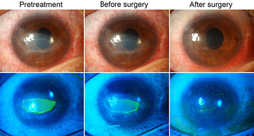 Remodeling of the Corneal Epithelial Scaffold for Treatment of ...