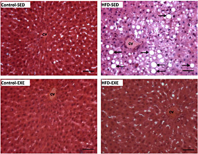 Fig. 5. Moderate exercise attenuates liver steatosis in HFD fed rats. Photomicrographs of livers (H&E stain; 20× objective magnification; bars = 100 µm; n = 6) from the Control-SED group show a typical liver (upper left panel). HFD-SED group livers show macro- and micro-vesicular steatosis (upper right panel, arrows). Moderate exercise attenuates macro-and micro-vesicular steatosis in the HFD-EXE group (lower right panel). Moderate exercise training did not change the liver morphology in control rats (lower left panel) compared with the Control-SED group. CV = central vein.