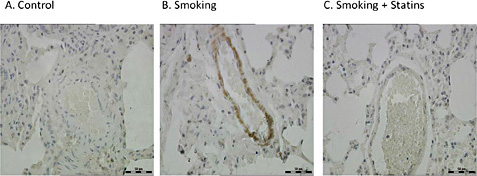 Fig. 4. Expression of 5-HTT in lung tissue. Rat lung tissues were immunostained for 5-HTT as described in the methods. (Panel A) Control group. (Panel B) Smoke-exposed group. (Panel C) Simvastatin group. Data presented was one representative of 10 biological replicates. Magnification: x400.