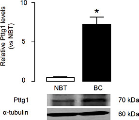 Fig. 1. Overexpression of Pttg1 is detected in BC specimen. The resected specimens (paired BC tissue and the adjacent normal breast tissue (NBT)) from the 27 BC patients were analyzed for Pttg1 levels by Western blot. We found that compared to NBT, BC tissue had a significantly higher Pttg1 levels (Fig. 1, p<0.05, more than 7-fold increase). *p<0.05. n=27. Statistics: one-way ANOVA with a Bonferoni correction.