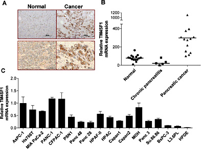Fig. 1. TM4SF1 was overexpressed in pancreatic tumors and cancer cell lines. (A) Immunohistochemical analysis showing the location of TM4SF1 in samples of pancreatic adenocarcinoma and adjacent benign pancreatic tissue at a magnification of ×200. The normal tissue samples exhibited only slight staining for TM4SF1. In contrast, the adenocarcinoma sample showed strong staining. (B) qRT-PCR analysis of the TM4SF1 mRNA expression in normal pancreatic tissue, chronic pancreatitis tissue and pancreatic adenocarcinoma samples. The expression of TM4SF1 was higher in pancreatic adenocarcinomas than normal pancreatic and chronic pancreatitis tissues. (C) the mRNA expression of TM4SF1 was higher in the cancer cell lines than in HPDE cells.