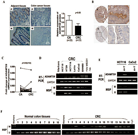 Fig. 1. Expression and methylation status of ADAMTS9 in colorectal cancer. (A).Left:Immunohistochemical staining of ADAMTS9 in human colon carcinoma tissues and cancer adjacent normal tissues. right: Quantitative analysis of mean optical density (MOD) of ADAMTS9 expression in two groups was shown as values of mean±SD (p<0.05). (B) ADAMTS9 protein show cytoplasmic and membranous localization. Data is from the human protein atlas (http://wwwproteinatlas.org/).a:colon normal tissue, b:colon adenocarcinoma. (C) ADAMTS9 expression level in paired colorectal cancer tissues by quantitative real-time PCR. (D) ADAMTS9 expression and methylation status of the ADAMTS9 promoter by MSP in a panel of human colorectal cancer cell lines by semi-quantitative PCR, GAPDH was used as control. +Ve MB231: breast cancer cell line MB231 was used as positive control. –Ve: negative control. M: methylated; U: unmethylated. (E) Pharmacological demethylation restored expression of ADAMTS9. HCT116 and CaCo2 were treated with Aza combined with TSA (A+T). ADAMTS9 expression level examined by semi-quantitative PCR and methylation status of the ADAMTS9 promoter by MSP in HCT116 and CaCo2 cell lines after A+T treatment. GAPDH was used as control. (F) left: Mehtylation status of ADAMTS9 in normal colon tissues. right: Mehtylation status of ADAMTS9 in colorectal cancer tissues.