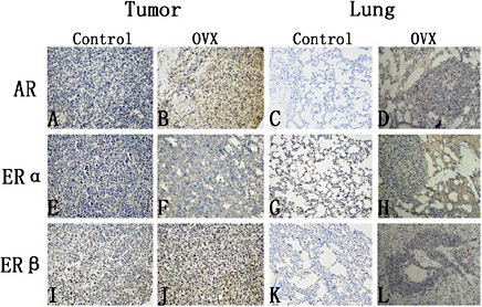 Fig. 5. AR, ERα and ERβ protein expression levels in transplanted tumour and lung tissues from the two groups (IHC, ×200 magnification). A-D. AR protein expression levels. E-H. ERα protein expression levels. I-L. ERβ protein expression levels. The protein expression levels in transplanted tumour and lung tissues were significantly higher in the ovariectomized group than in the control group. In addition, ERβ protein expression in tumour tissue and ERα protein expression in lung tissue were obviously high. Control: mice treated with partial bilateral fat pad removal near the ovary; OVX: ovariectomized, mice treated with bilateral ovary resection.