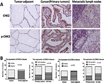 Fig. 1. The levels of CHK2 expression and activation in papillary thyroid cancer tissues. (A) The expression levels of CHK2 and pCHK2 in tissues were detected using IHC (200×magnification). (B) The levels of CHK2 and p-CHK2 in cancer, matched tumor-adjacent thyroid tissues and metastatic lymph nodes (LN mets) were analyzed using the Pearson χ2 test.