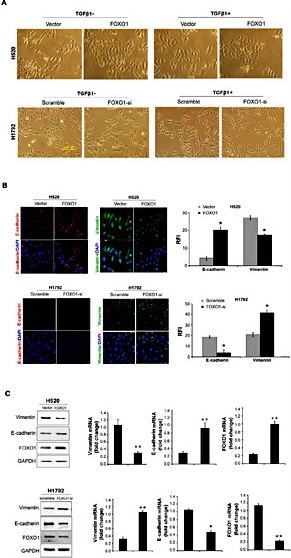 Fig. 4. FOXO1 inhibits TGF-β1-induced EMT in NSCLC cells. (A) Morphology of H520/vector, H520/FOXO1, H1792/siCtrl, and H1792/FOXO1si cells with or without TGF-β1 treatment (10 ng/ml) for 24 h. (B) E-cadherin and Vimentin in H520/FOXO1 and H1792/FOXO1si cells with TGF-β1 treatment (10 ng/ml) for 48 h were detected by immunofluorescence staining. Statistical analysis showed the relative fluorescence intensity of E-cadherin or Vimentin. Quantification of the fluorescent intensity was performed using Image J. Values represent means ± SD of three independent experiments. * indicates p< 0.05*. (C) E-cadherin and Vimentin in H520/FOXO1 and H1792/FOXO1si cells after TGF-β1 treatment (10 ng/ml) for 48 h were detected by western blotting and real-time PCR
