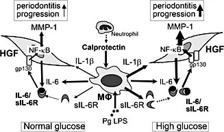 Fig. 7. Schematic representation of HG-mediated HGFs and macrophages crosstalk: A possible mechanism of severe periodontitis with diabetes. In inflamed periodontal tissues of diabetic patients, calprotectin produced by neutrophils induces sIL-6R production in macrophages. HG induces IL-1β and sIL-6R production in macrophages. In the pathogenesis of periodontitis, macrophages may be one of the key cells, because Pg LPS also induces IL-6 production. IL-1β and sIL-6R induce MMP-1 production synergistically in HGFs, because IL-1β induces dramatically IL-6 production in HGFs. Taken together, both direct effects of IL-1β on responsiveness of HGFs and indirect effects of IL-1β via activation of IL-6 signaling of HGFs by inducing sIL-6R from macrophages infiltrated in periodontitis lesion may exacerbate the pathogenesis of periodontitis synergistically in diabetic patients.