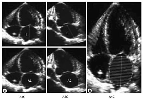 LA volume calculation using 2D echocardiography. a Biplane area-length method using the formula V = 8(A1)(A2)/ 3π(L), where V is volume, A1 and A2 represent the LA planimetry in the apical 4-chamber (A4C) and 2-chamber (A2C) views, respectively, and L is the shortest length from the middle of the plane of the mitral annulus to the superior aspect of the LA. b Modified single-plane Simpson's rule, assuming the stacked disks are circular, using the formula V = π/4(h)Σ(D), where V is volume, h is the height of the disks and D is the orthogonal axis of the disks.