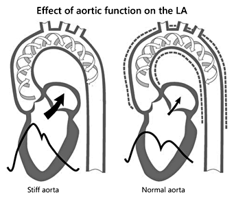 Schematic representation of reflected waves in the aorta. In a normally functioning aorta, the reflected waves reach the root of the aorta early in diastole, resulting in the formation of the diastolic wave that facilitates coronary blood flow. When the aorta is stiff, the reflected waves reach the aortic root at the end of systole, resulting in the disappearance of the diastolic wave and the development of systolic arterial hypertension.