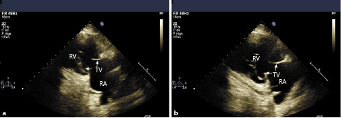 Carcinoid Heart Disease: Pathophysiology, Pathology, Clinical ...