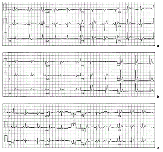Fig. 1. Familial idiopathic short QTI. a Twelve-lead ECG from 17-year-old patient with a QTI duration of 71% of predictive value. Note: QTI duration 280 ms; heart rate 69 bpm; predictive value of QTI 393 ms; QTc (by Bazzet’s formula) 300 ms; QRS duration 88 ms. b 12-lead ECG from 21-year-old brother with a QTI duration of 66% of predictive value. Note: QTI duration 272 ms; heart rate 58 bpm; predictive value of QTI 415 ms; QTc (by Bazzet’s formula) 267 ms; QRS duration 84 ms (half standard). c 12-lead ECG from 51-year-old mother with a QTI duration of 69% of predictive value. Note: QTI duration 260 ms; heart rate 74 bpm; predictive value of QTI 377 ms; QTc (by Bazzet’s formula) 289 ms; QRS duration 80 ms.